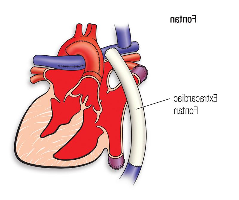 Fontan repair diagram
