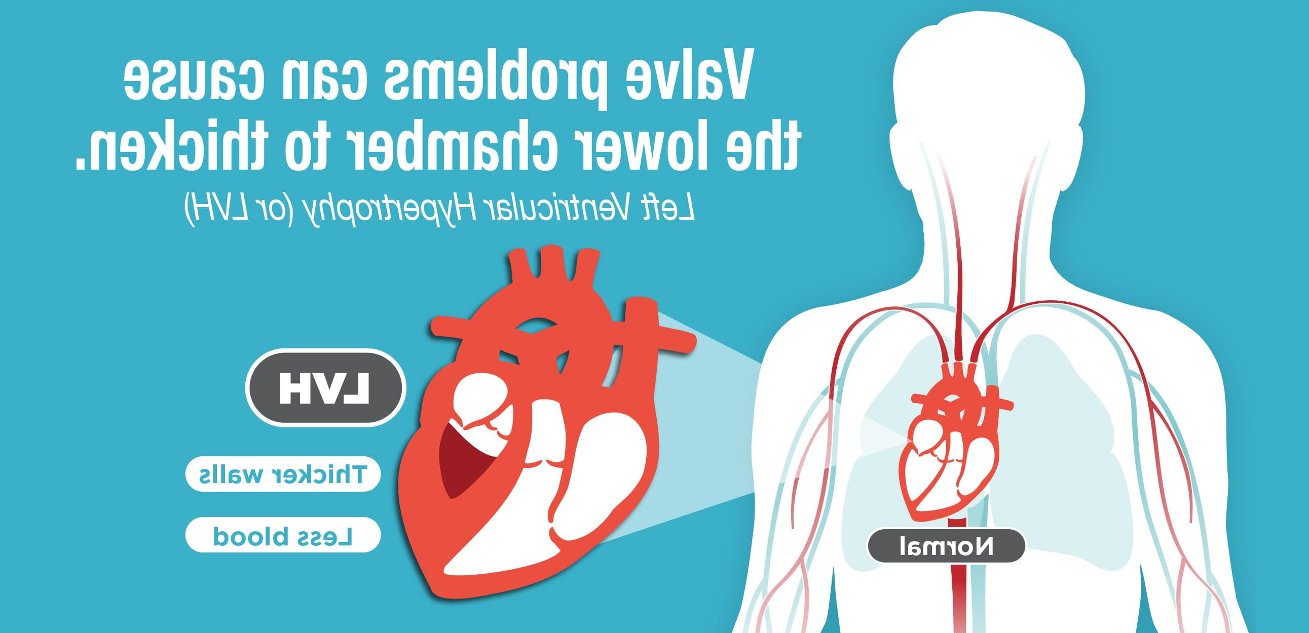 Left Ventricular Hypertrophy LVH banner